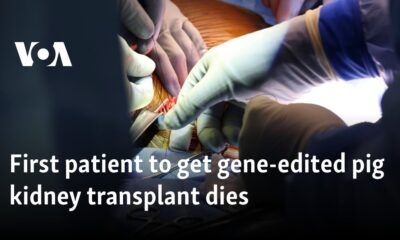 First patient to get gene-edited pig kidney transplant dies 