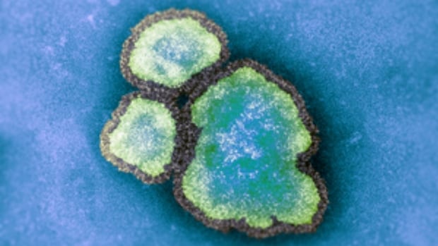 Hamilton child under 5 dies of measles: public health agency