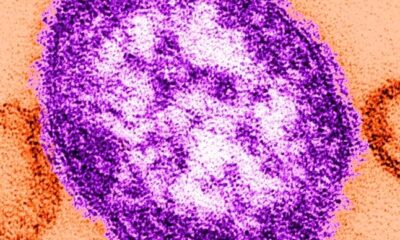 Unimmunized young child dies after contracting measles: Report